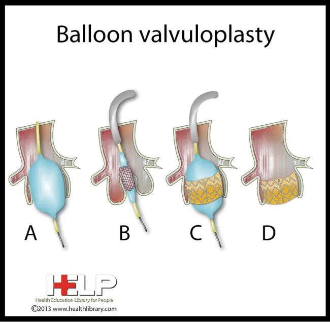 Balloon Aortic Valvuloplasty : 主动脉瓣球囊成形术