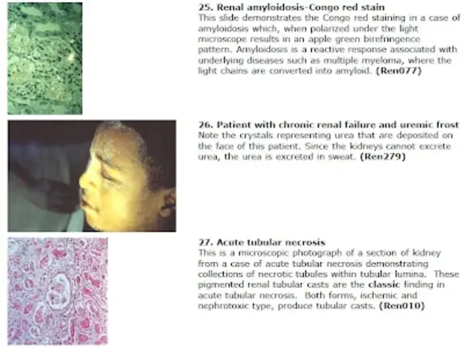 Giand Cell Arteritis : 巨细胞动脉炎