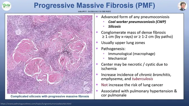 Progressive Massive Fibrosis : 进行性大纤维化