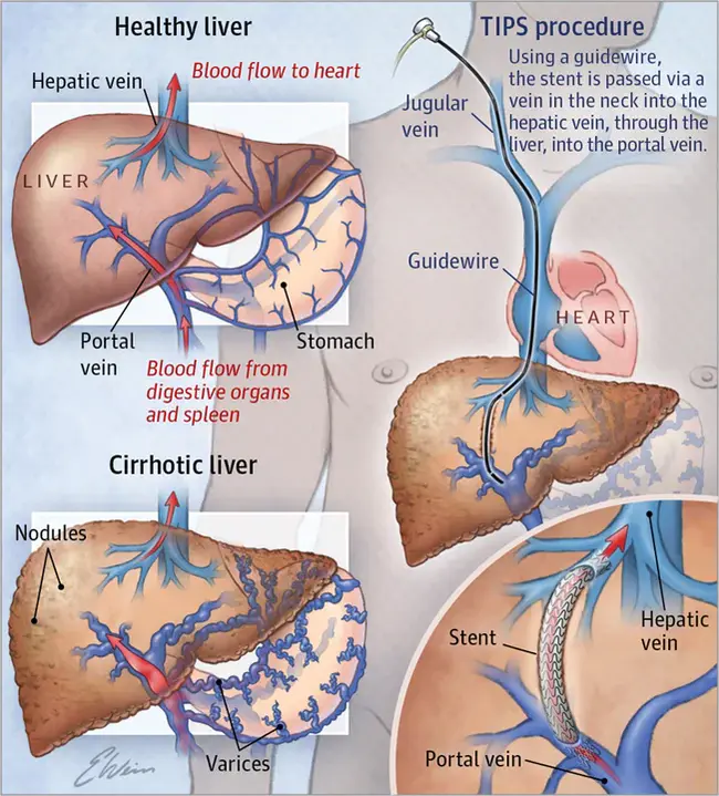 Transhepatic Intrahepatic Portosystemic Shunt : 肝内肝门系统分流术