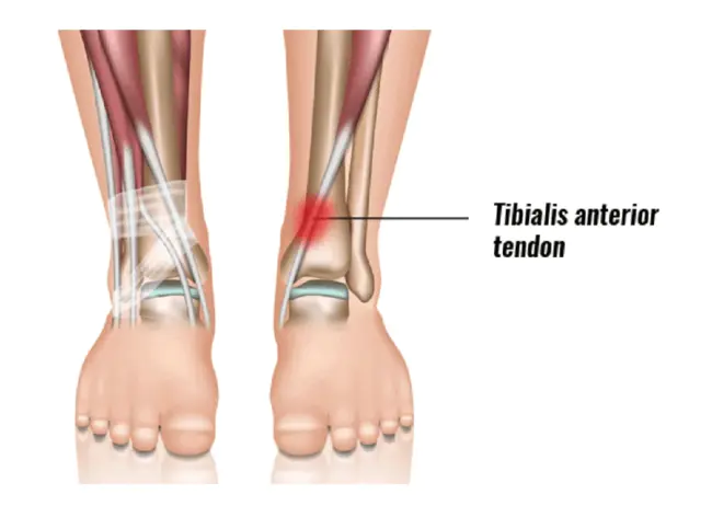 Anterior Talofibular : 距骨前