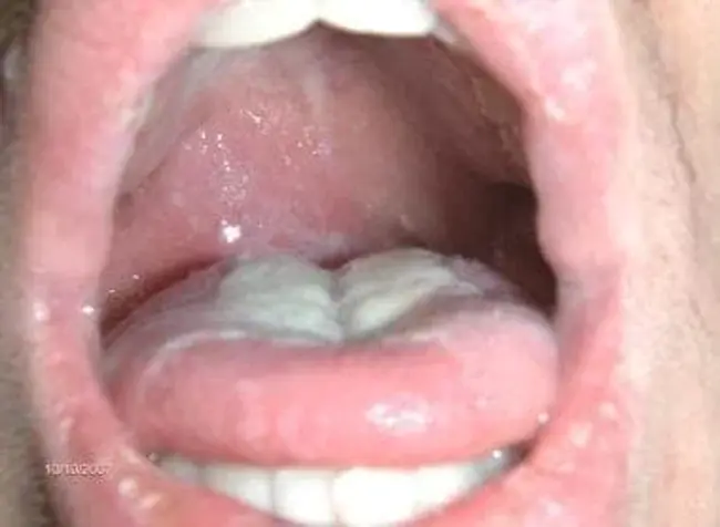 PeriTonsillar Abscess : 扁桃体周围脓肿