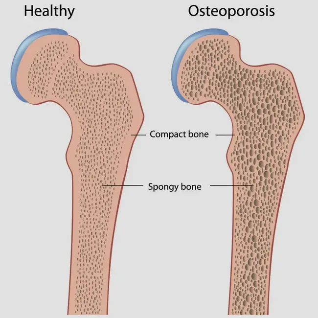 OsteoPorosis : 骨质疏松症