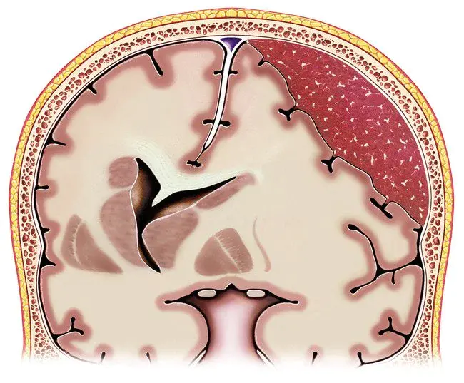 SubDural Hematoma : 硬膜下血肿