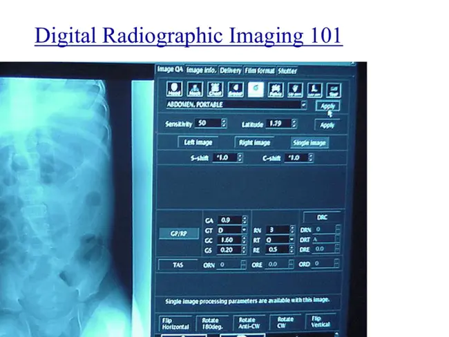 Digital X-ray Radiogrammetry : 数字X射线辐射测量