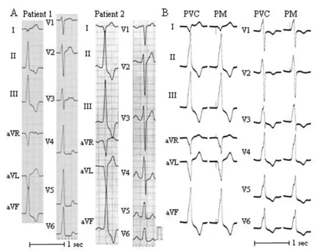 Premature Ventricular Tachycardia : 室性早搏