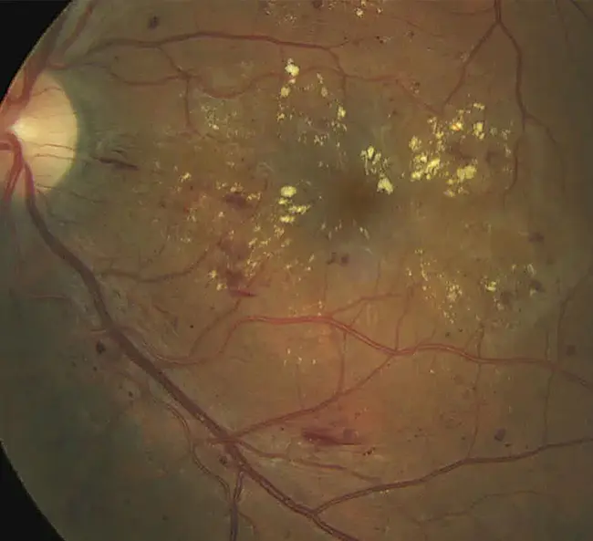 Intra-Retinal Microvascular Anomaly : 视网膜内微血管异常