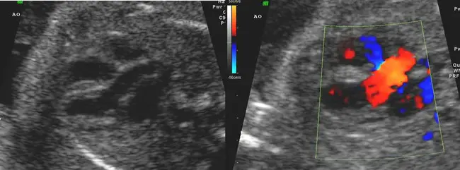 Inferior Mesenteric Artery : 肠系膜下动脉