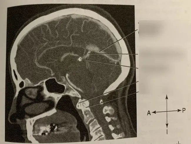 Ventral Tegmental Area : 腹侧被盖区