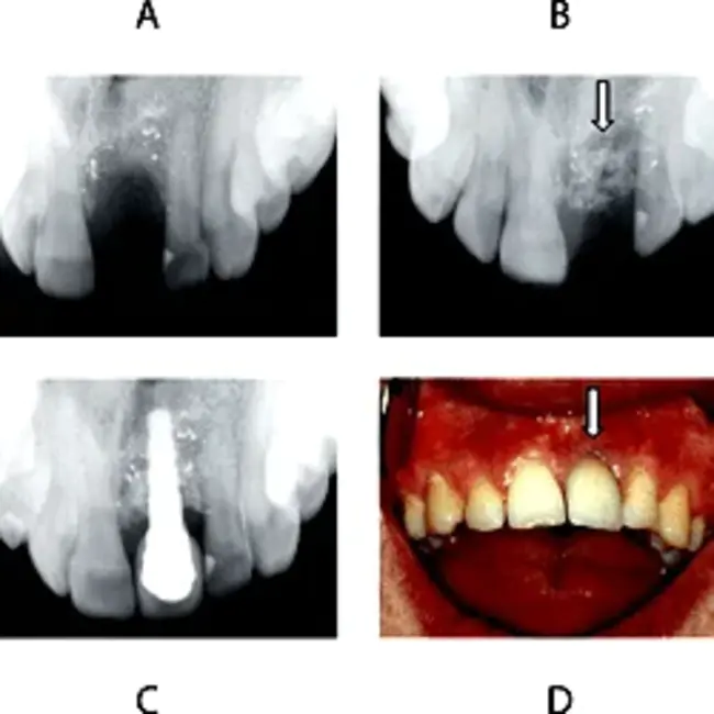 Diffuse Alveolar Damage : 弥漫性肺泡损伤