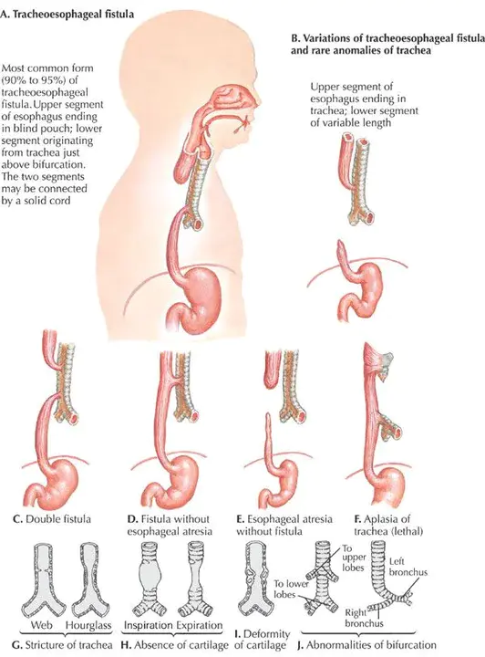 TracheOesophageal : 气管食管