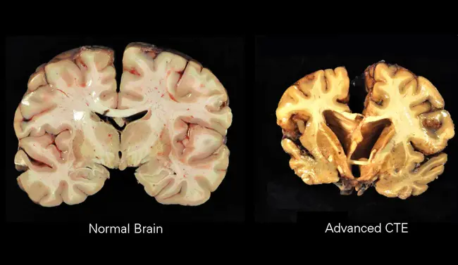 Chronic Traumatic Encephalopathy : 慢性创伤脑部病变