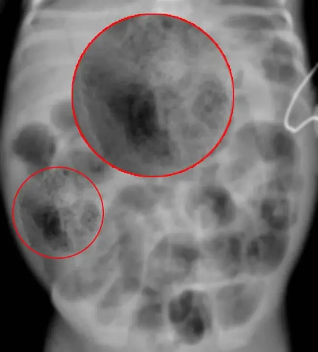 Necrotizing EnteroColitis : 坏死性小肠结肠炎