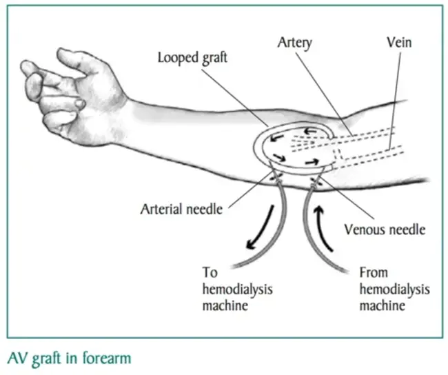 Continuous Arterio-Venous Hemo-Dialysis : 持续动静脉血液透析