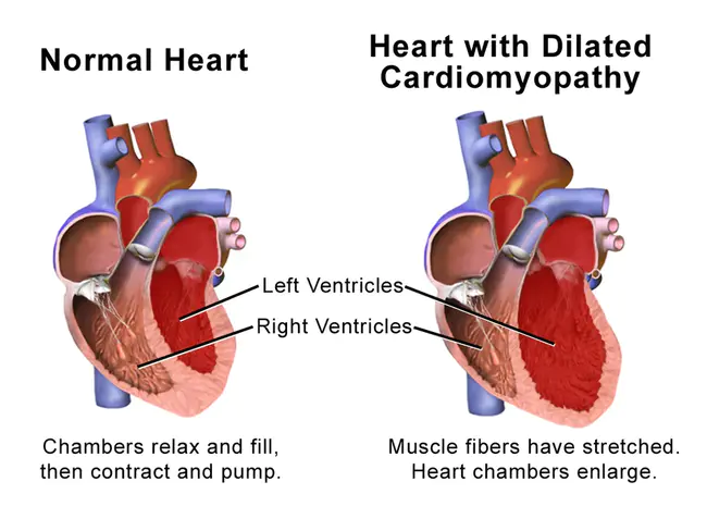 CardioMyoPathy : 心肌病