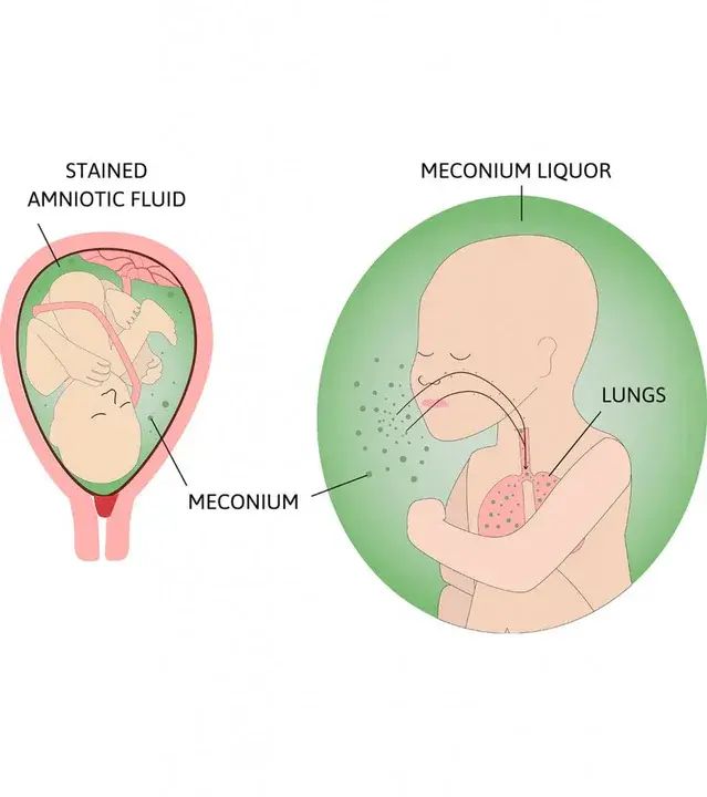 Meconium Aspiration Syndrome : 胎粪吸入综合症