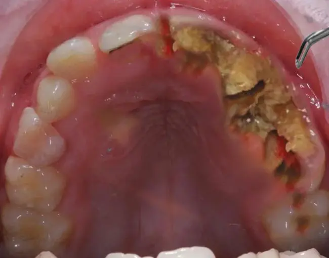 OsteoNecrosis of the Jaw : 颌骨坏死