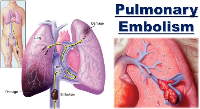 Pulmonary Vascular Resistance : 肺血管阻力