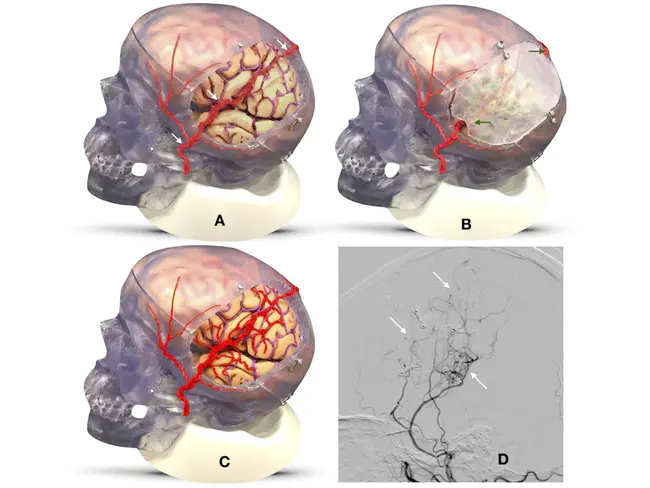 Encephalo-Duro-Arterio-Synangiosis : 脑-硬脑膜-动脉-联结