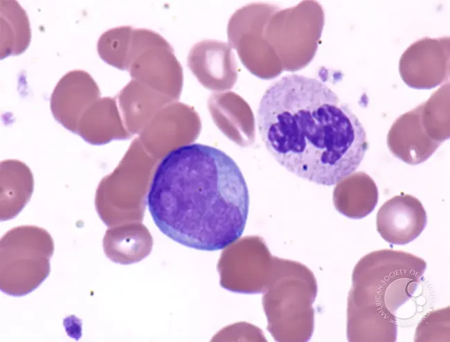 Agnogenic Myeloid Metaplasia : 不可知性骨髓样化生