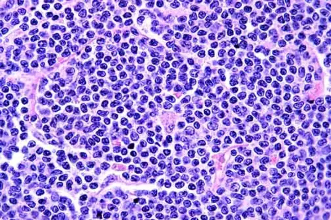 Mantle Cell Lymphoma : 套细胞淋巴瘤