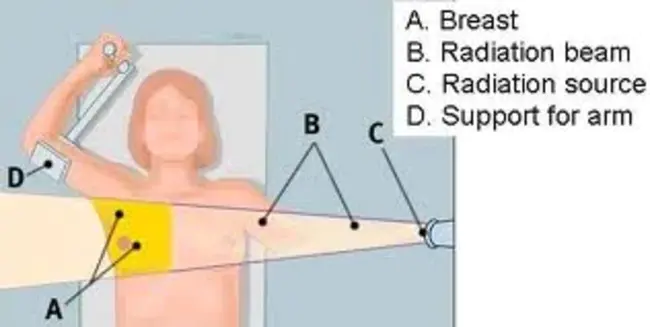 Radiation-Induced Brachial Plexopath : 辐射性臂丛神经病变