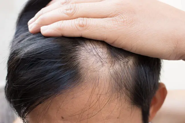 Alopecia Areata : 斑秃