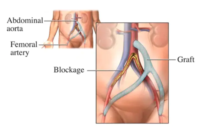 AortoFemoral Bypass : 主动脉股动脉旁路