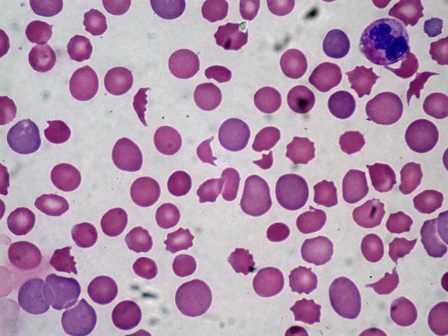 MicroAngiopathic Hemolytic Anemia : 微血管病性溶血性贫血