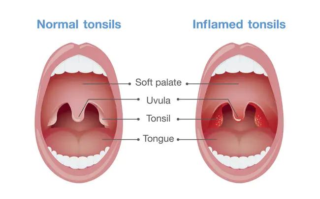 Tonsils aNd Adnoids : 扁桃体和小管