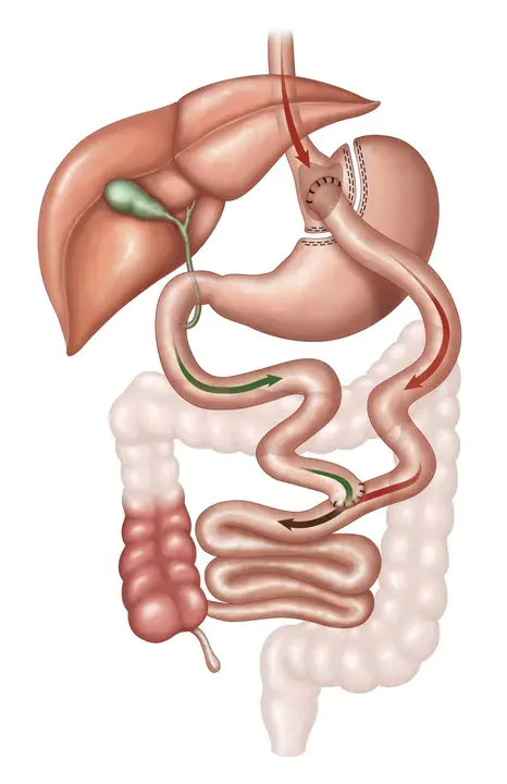 Post-Gastric Bypass Reconstruction : 胃旁路术后重建