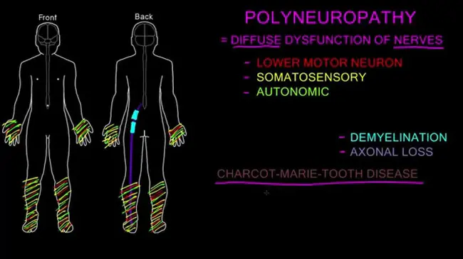 PolyNeuroPathy : 多发性神经病