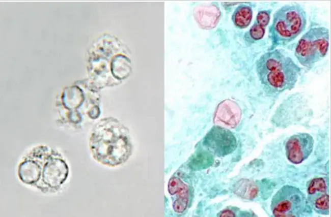 PolyMorphonuclear Leukocytes : 多形核白细胞