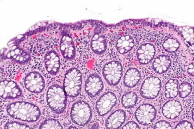 Intra-Epithelial Lymphocytes : 上皮内淋巴细胞