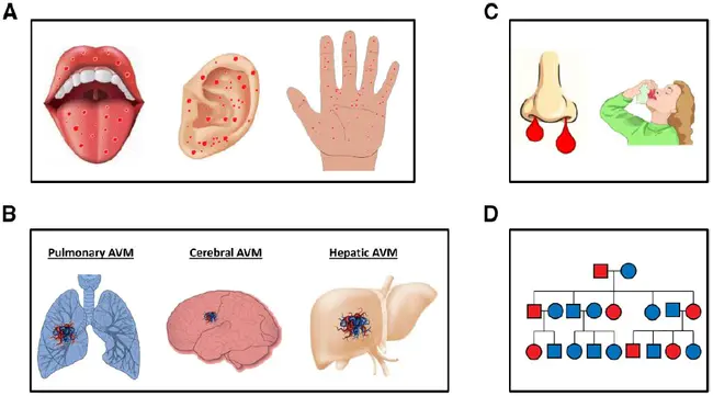 Hereditary Hemorrhagic Telangiectasia Foundation International : 遗传性出血性毛细血管扩张症国际基金会