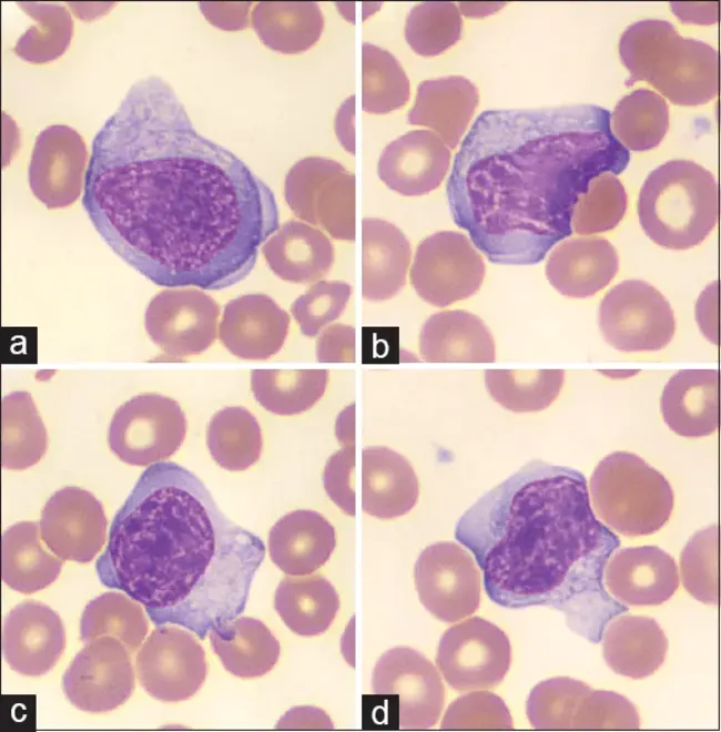 Atypical Adenomatous Hyperplasia : 非典型腺瘤性增生