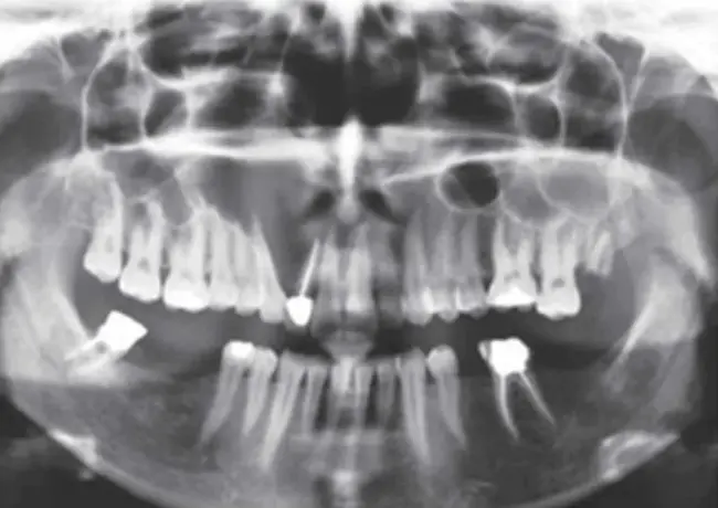 Odontogenic KeratoCyst : 牙源性角化囊肿