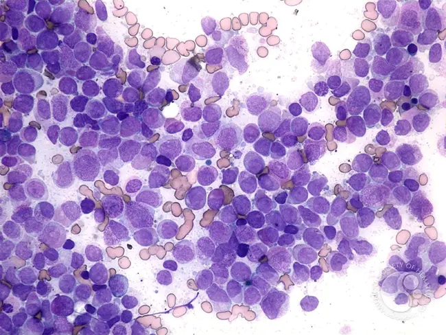 ProLymphocytic Leukaemia : 无性系白血病