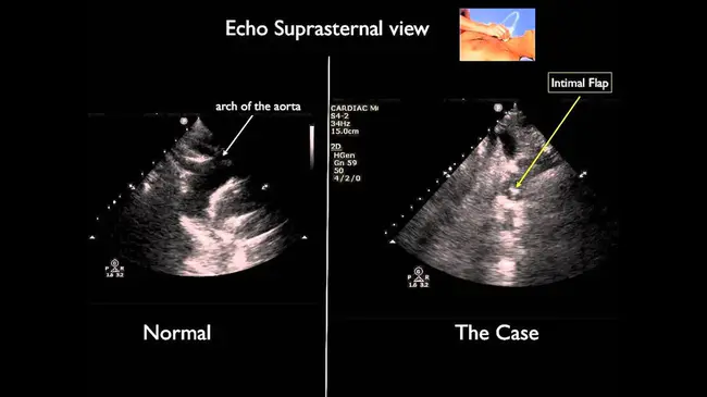 SupraSternal Notch : 胸骨上切口