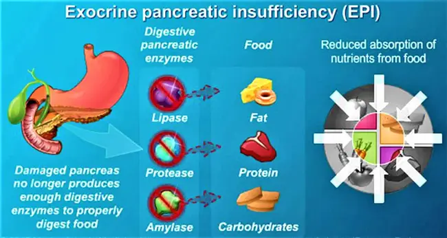 Exocrine Pancreatic Insufficiency : 胰腺外分泌功能不全