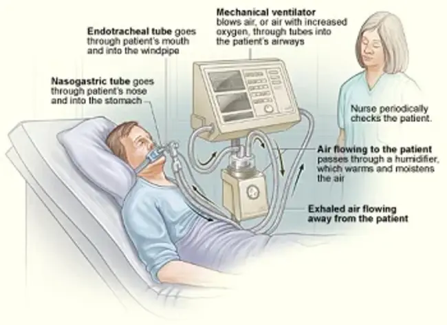 Ventillator-associated Lung Injury : 通气相关肺损伤