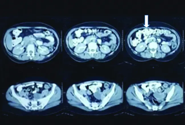 Superior Mesenteric Vein : 肠系膜上静脉