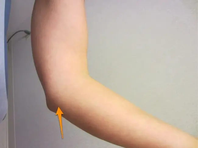 Ulnar Collateral Ligament : 尺侧副韧带