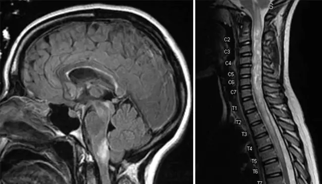 NeuroMyelitis Optica : 视神经脊髓炎