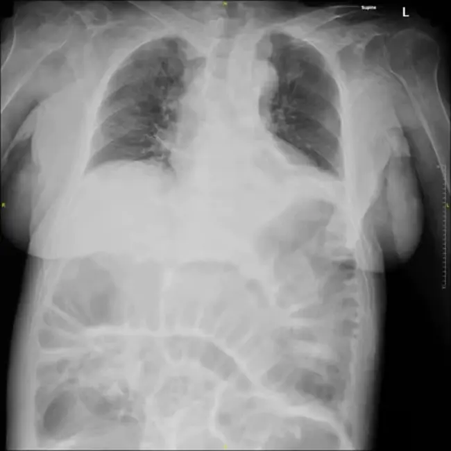 Radiologically Inserted Gastrostomy : 放射学插入胃造口术
