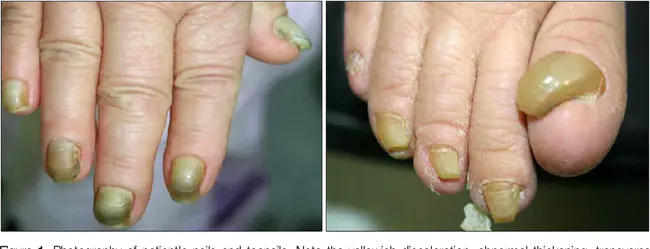 Yellow Nail Syndrome : 黄指甲综合征