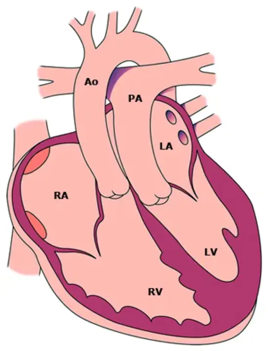 Dextro-Transposition of the Great Arteries : 大动脉右旋转位