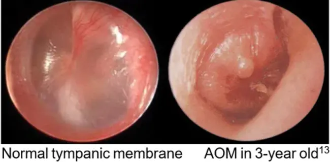 Acute Disseminated EncephaloMyelitis : 急性播散性脑脊髓炎