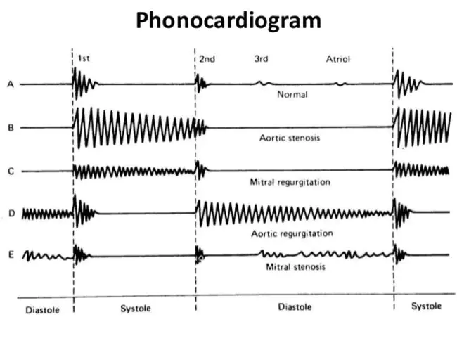 PhonoCardioGram : 心音图