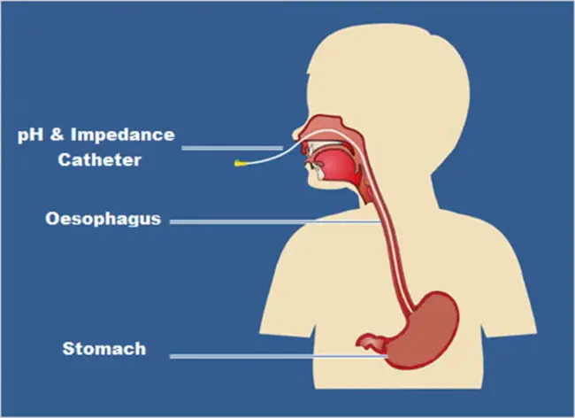 Impedance PNeumogram : 阻抗肺图